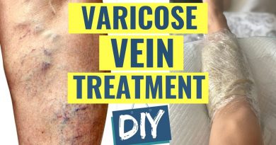 How to Treat Varicose Veins at Home | Natural Varicose Vein Treatment | Fix Varicose Veins
