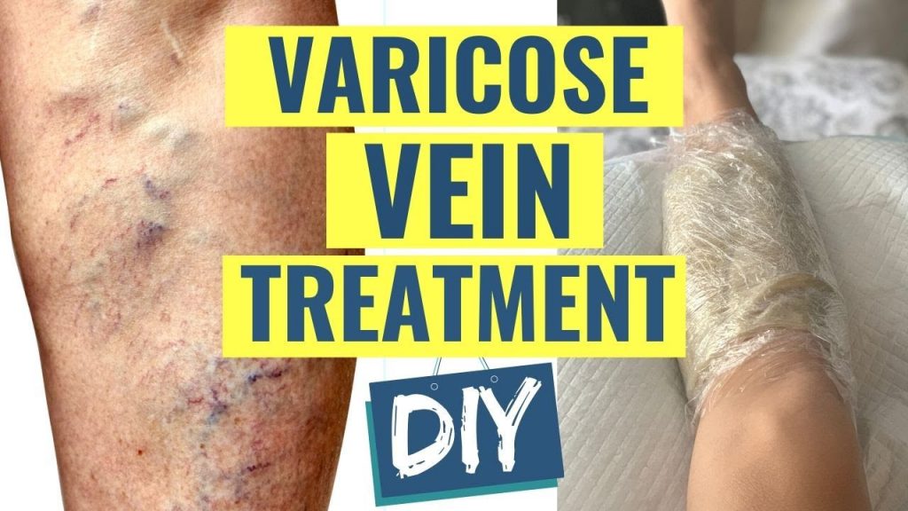 How to Treat Varicose Veins at Home | Natural Varicose ...