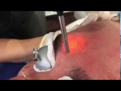 Laser Hair Removal Male Grooming