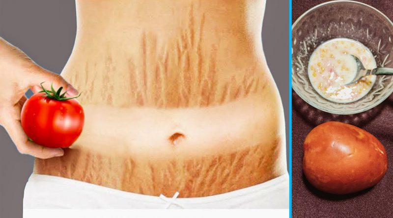 Get Rid Of Stretch Marks Fast With Tomato And Toothpaste, Natural Treatment For Stretch Marks