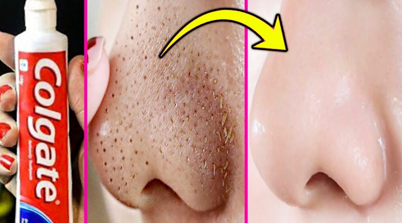 How To Get Rid Of Blackheads On Nose With Toothpaste / Remove Blackheads At Home Instantly