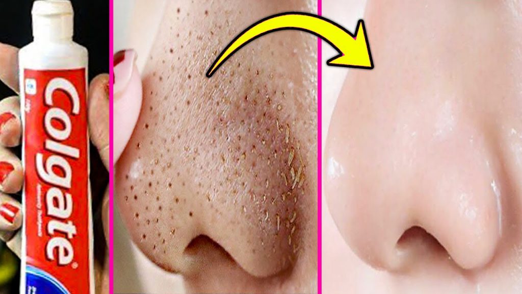 How To Remove Blackheads On Nose Using Toothpaste