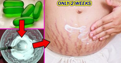How To Get Rid Of Stretch Marks | How To Remove Stretch Marks Fast Permanently At Home