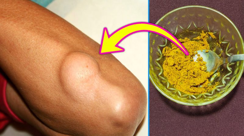 How To Remove Lipoma Naturally At Home, Lipoma Removal Home Remedy