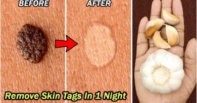 How To Remove Skin Tags In 1 Night | Natural Skin Tags Removal | Remove Skin Tags With Garlic