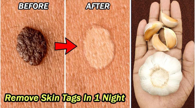 How To Remove Skin Tags In 1 Night | Natural Skin Tags Removal | Remove Skin Tags With Garlic