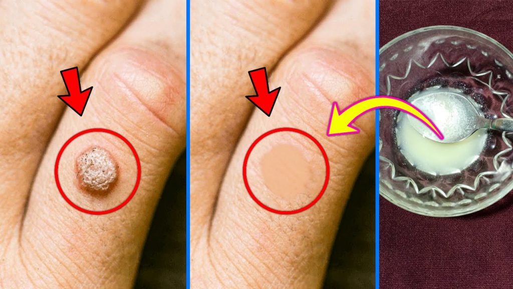 how to get rid of warts using apple cider vinegar