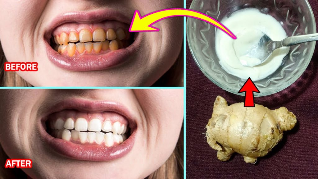 Home Remedy For Whitening Teeth Fast, Get Whiter Teeth With Baking Soda