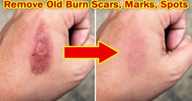 Best Way To Get Rid Of Old Burn Scars, Burn Marks Treatment, Burn Spots Home Remedy
