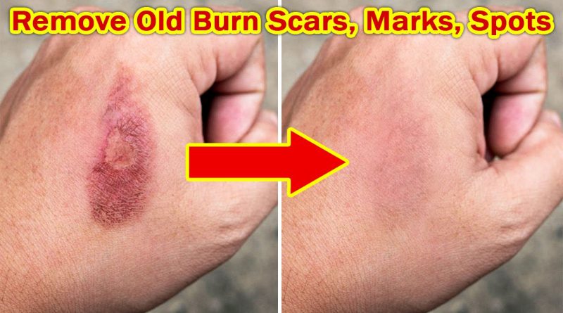 Best Way To Get Rid Of Old Burn Scars, Burn Marks Treatment, Burn Spots Home Remedy